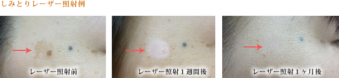 フェイシャルレーザー 当医院での実際の施術症例
