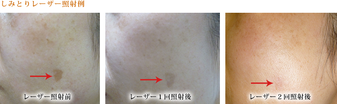 フェイシャルレーザー 当医院での実際の施術症例