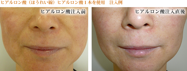 ヒアルロン酸注入　当医院での実際の施術症例