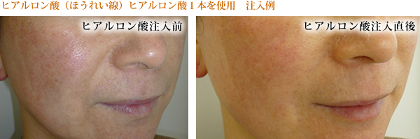 ヒアルロン酸注入　当医院での実際の施術症例